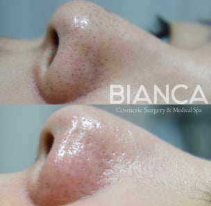 ハイドラフェイシャル（Hydrafacial）による毛穴の汚れ・角質除去・肌質改善の症例写真・ビフォーアフター