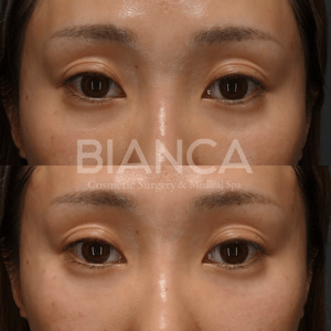 ベビーコラーゲンによる目の下の凹み・クマ・ちりめんジワなどの改善症例・ビフォーアフター