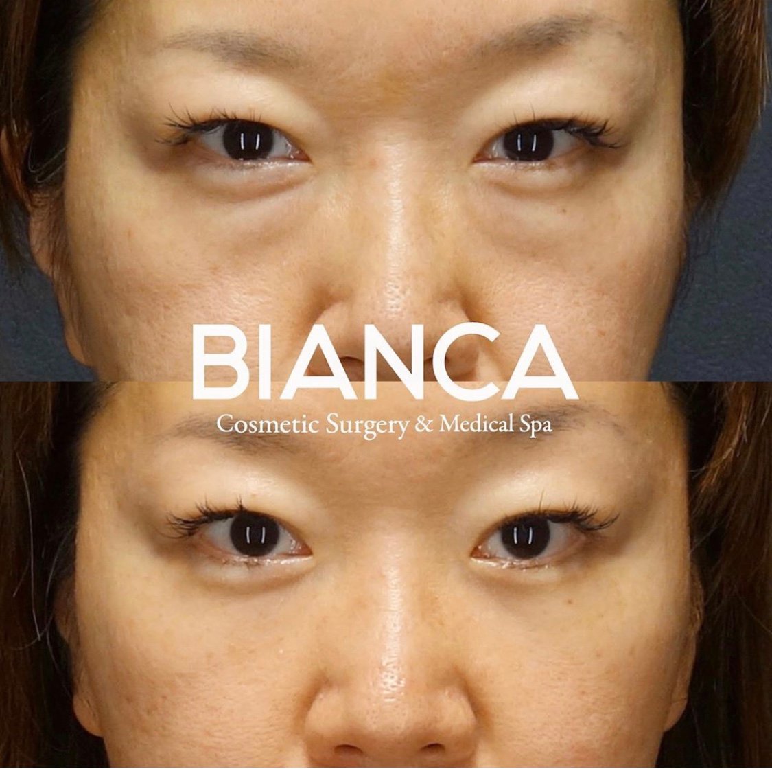 目の下クマ・たるみ取り(経結膜脱脂術)で目元がスッキリした症例写真・ビフォーアフター クマ取り(経結膜脱脂術)の経過は?腫れ・内出血・仕上がりを医師が解説【ビアンカクリニック】