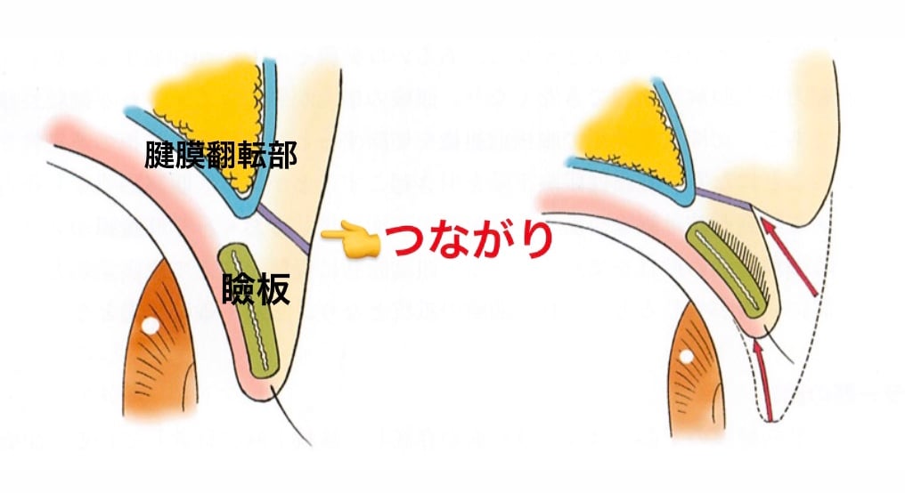 二重埋没法を比較！2点留め・4点留め・クロスリンク・BAメソッド・MT法でダウンタイムと持続力はどう違う？【医師監修】
