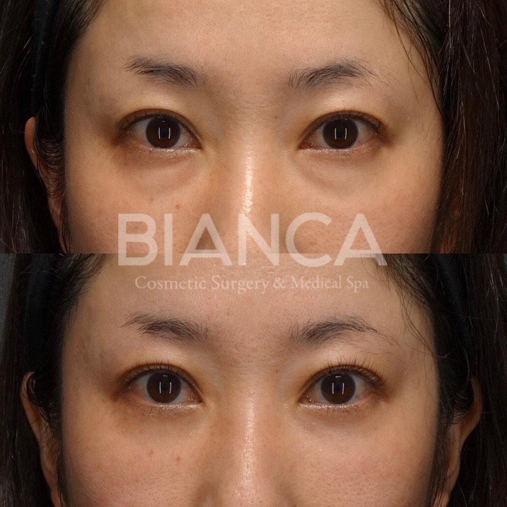 目の下クマ・たるみ取り(経結膜脱脂術)で目元がスッキリした症例写真・ビフォーアフター クマ取り(経結膜脱脂術)の経過は?腫れ・内出血・仕上がりを医師が解説【ビアンカクリニック】