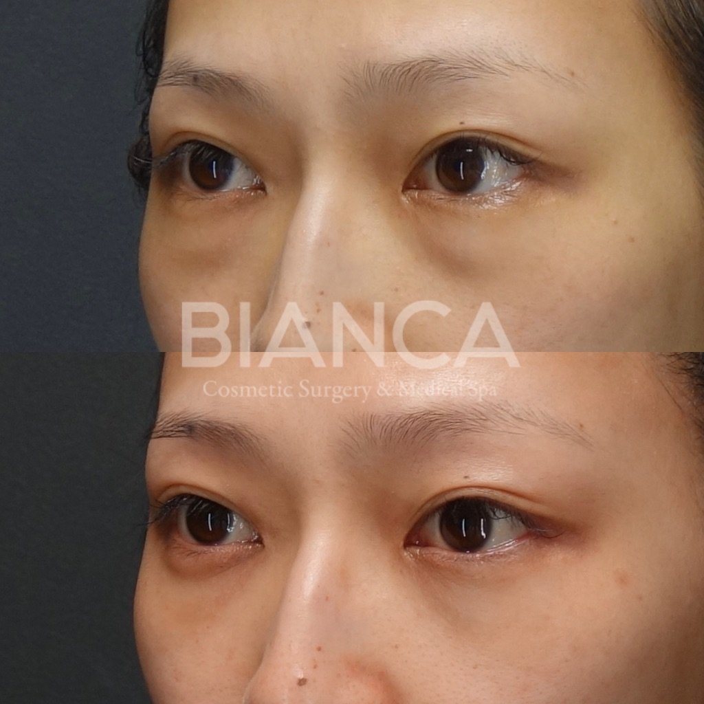 目の下クマ・たるみ取り(経結膜脱脂術)で目元がスッキリした症例写真・ビフォーアフター クマ取り(経結膜脱脂術)の経過は?腫れ・内出血・仕上がりを医師が解説【ビアンカクリニック】