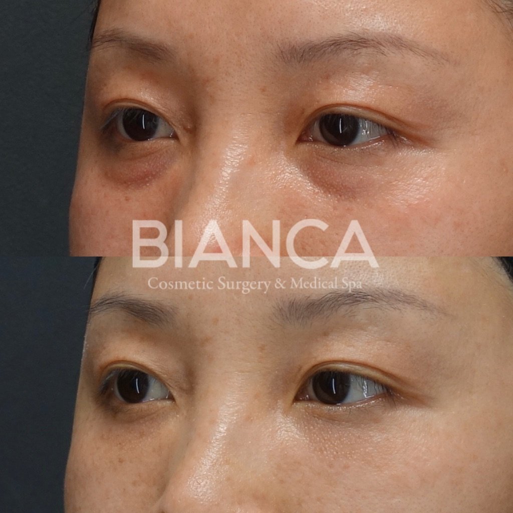 目の下クマ・たるみ取り(経結膜脱脂術)とコンデンスリッチフェイス(CRF)目の下によるクマ治療、症例写真・ビフォーアフター クマ取り(経結膜脱脂術)の経過は?腫れ・内出血・仕上がりを医師が解説【ビアンカクリニック】