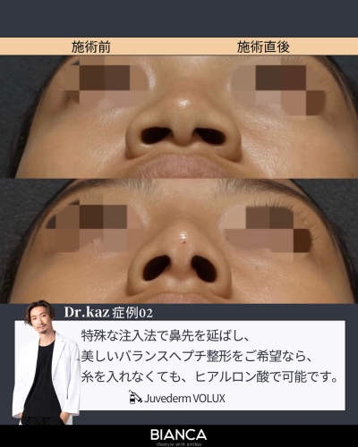 堀田医師のヒアルロン酸注入症例紹介