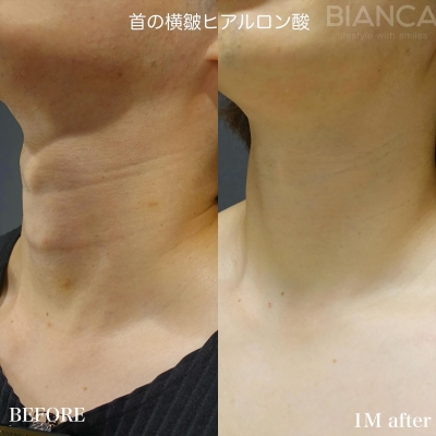 南寿美医師のヒアルロン酸注入
