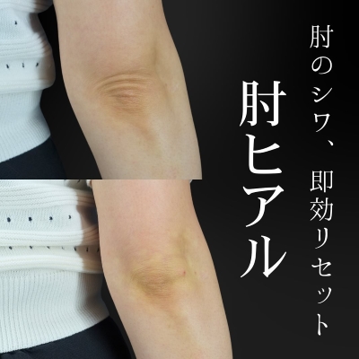 明石仙姫医師のヒアルロン酸注入