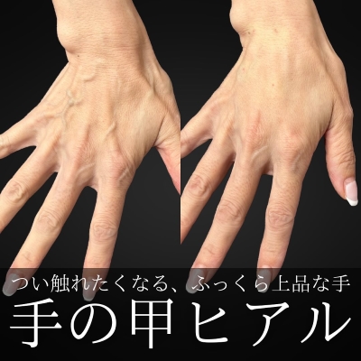 明石仙姫医師のヒアルロン酸注入