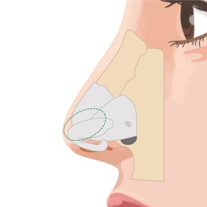 nasal septum lengthening