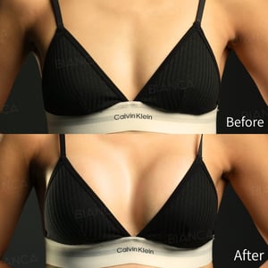 シリコンバッグ豊胸｜ビアンカ銀座｜日本を代表する美容健康再生医療のクリニック