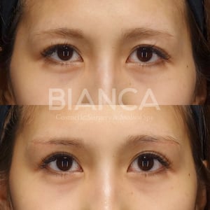 上:術前 下:術後1週間 抜糸直後<br />
📍眉下切開<br />
💴298,000円<br />
😷DT:腫れ・内出血 10日程度<br />
🤕抜糸:1週間後<br />
⚠️リスク:感染・左右差・瘢痕など