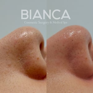 ハイドラフェイシャル（Hydrafacial）による毛穴の汚れ・角質除去・肌質改善の症例写真・ビフォーアフター