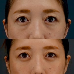 経結膜脱脂