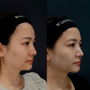 頬顎下脂肪吸引 BeforeAfter