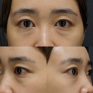 裏ハムラ　術前