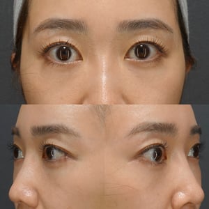 裏ハムラ　術後