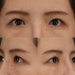 眉下切開　術後