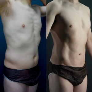 アブクラックスBeforeAfter