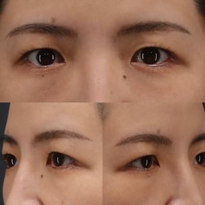 眉下切開　術前