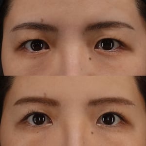眉下切開　B/A