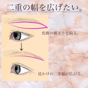 眉下切開　イラスト