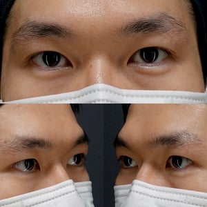 埋没法　術後