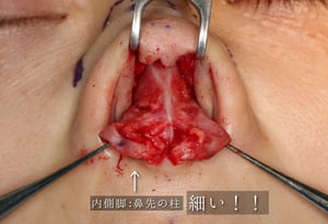 鼻修正