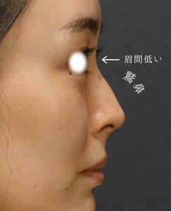 鷲鼻手術