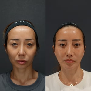 フェイスリフト