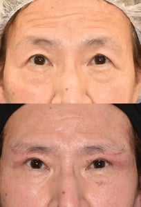 フェイスリフト手術