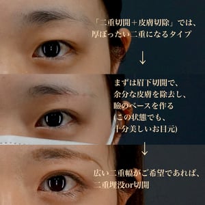 眉下切開、二重切開
