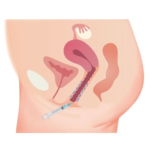 阴道注射玻尿酸