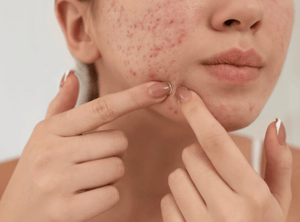 如何通过皮肤科医生治疗痤疮：成人皮肤的局部、口服和营养支持【医生指导】