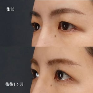 眉下切開