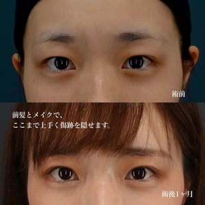 眉下切開