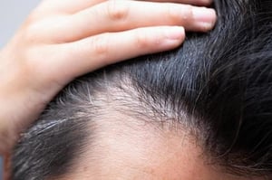 AGA治療の最前線｜“抜け毛を止める”から“育てる”時代へ。幹細胞注射・ペプチド療法・ターゲットクール・プルリアルを解説【ビアンカクリニック】