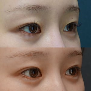 目尻切開、二重埋没