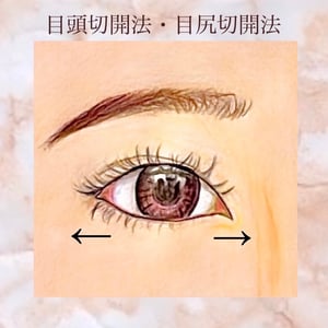 目頭切開、目尻切開