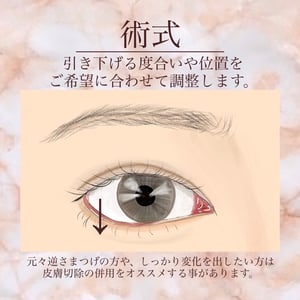 グラマラスライン形成