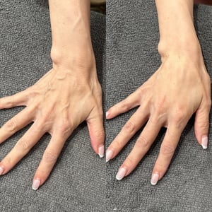 手の甲のシワをヒアルロン酸注入でケア!若々しい自然なハリを目指す方法