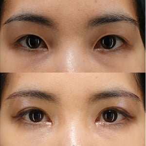二重埋没×目頭切開の症例