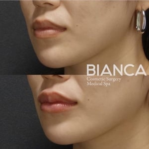 唇部玻尿酸注射的恢复期是多久？疼痛、肿胀及注意事项详解 | Bianca Ginza | 日本领先的美容、健康和再生医学诊所