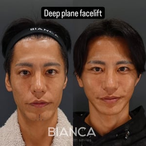 ディーププレーンフェイスリフト 男性のフェイスラインを引き締めるには?たるみの原因と改善アプローチを医師が解説【ビアンカクリニック】