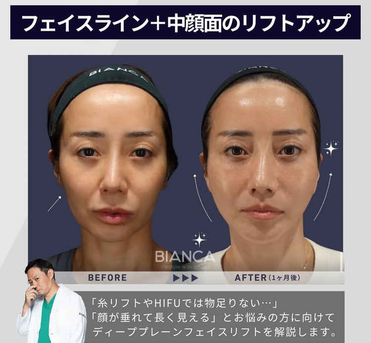 ディーププレーンフェイスリフト