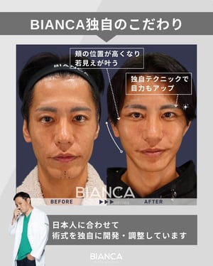 ディーププレーンフェイスリフト