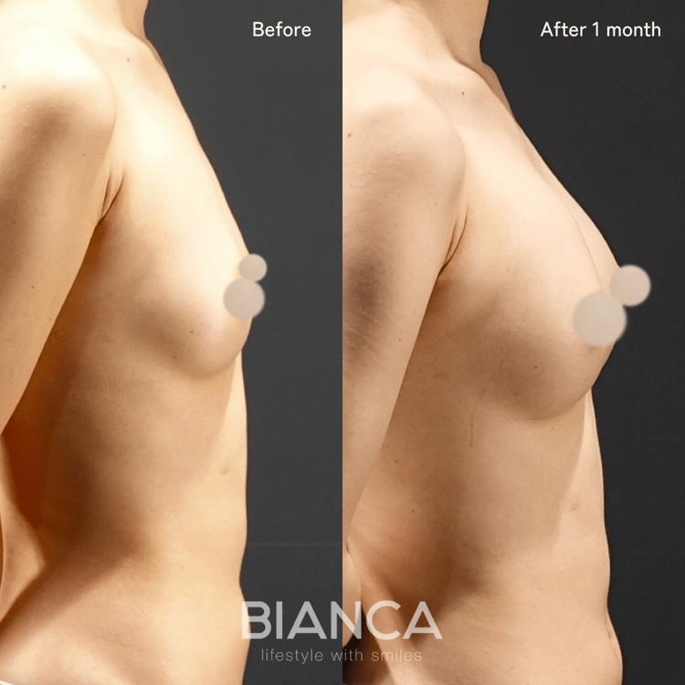 コンデンスリッチ脂肪注入豊胸