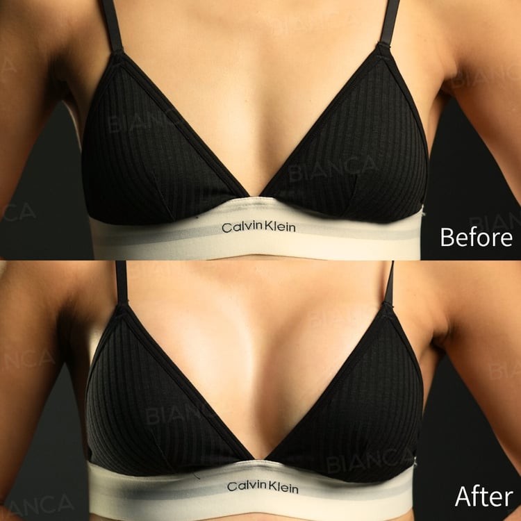 プリザベ（シリコンバッグ豊胸）