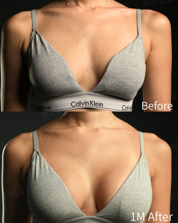 シリコンバッグ豊胸