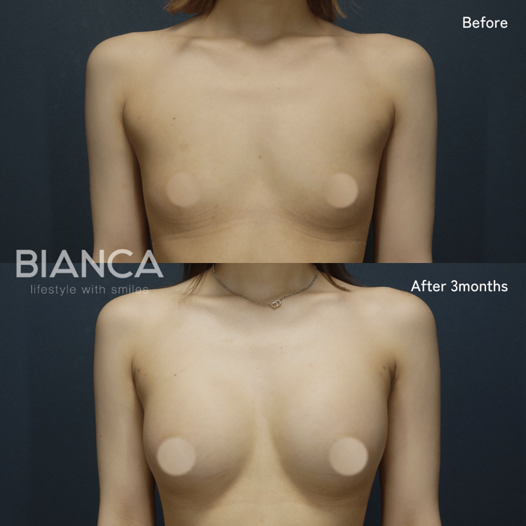 ハイブリッド豊胸