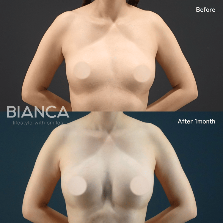 コンデンスリッチ脂肪注入豊胸