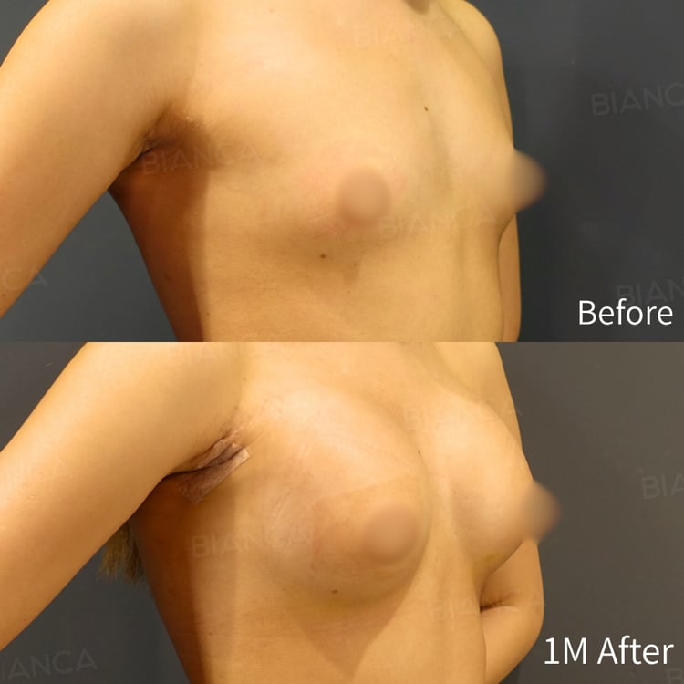 シリコンバッグ豊胸